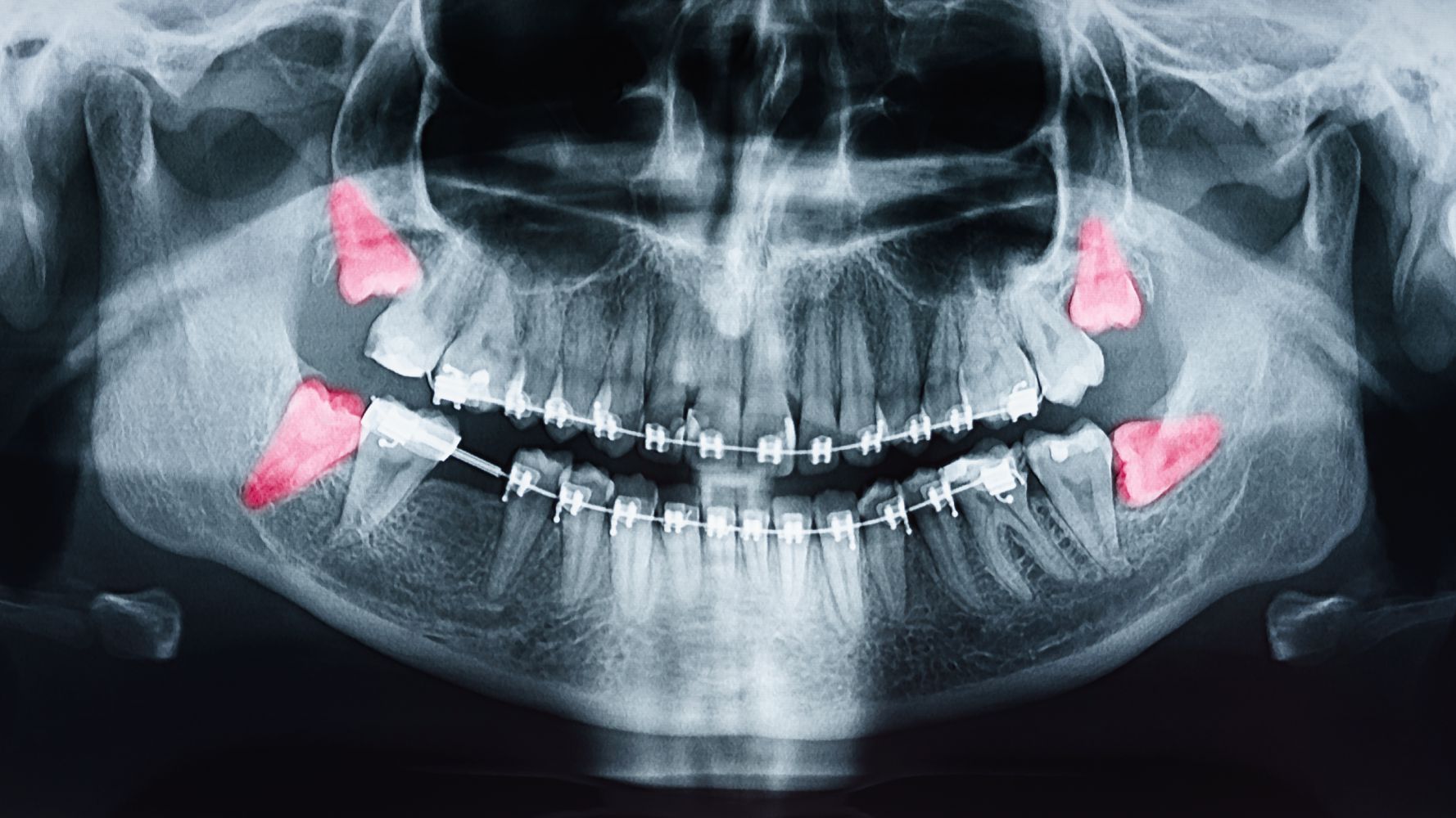 impacted teeth